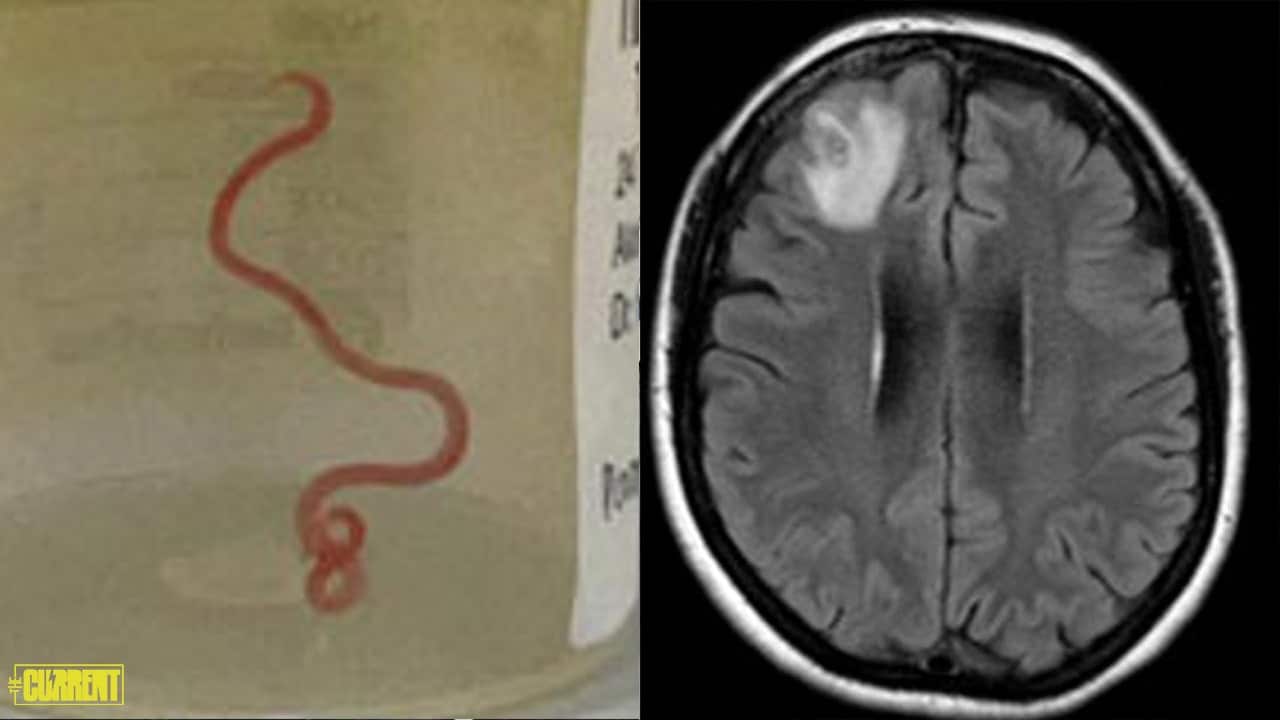 Live worm found in woman's brain during MRI scan